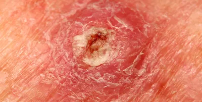 Меланома - рак кожи