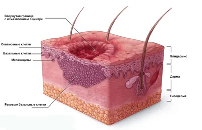 Рак кожи: симптомы, как выглядит, признаки, стадии, лечение