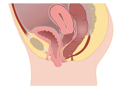 Цистоцеле: симптомы, диагностика, лечение, операция