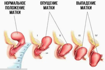 Хирургические сетки в лечении опущения тазовых органов и недержания мочи