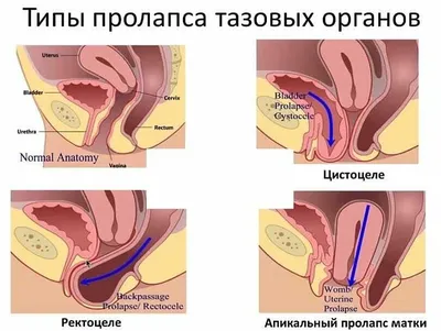 Опущение передней стенки матки, лечение и симптомы опущения передней и  задней стенок матки