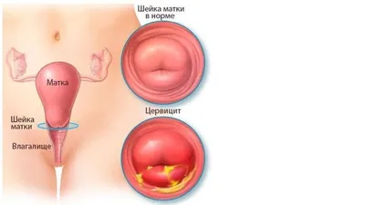 Copy of Тренировки при недержании мочи