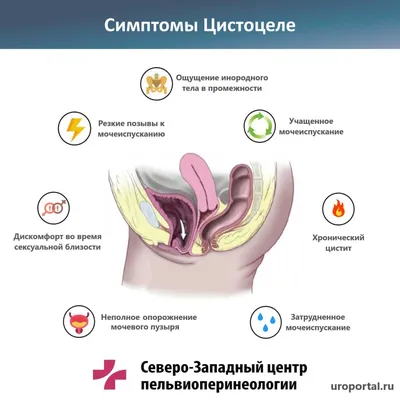 Опущение стенок влагалища: симптомы, лечение, коррекция | Клиника Частная  врачебная практика в Челябинске