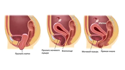 Лечение опущения и выпадения матки в Ташкенте. Диагностика и лечение в  частной клинике Gatling Med
