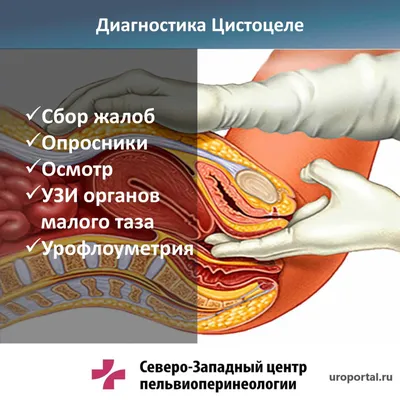 Что такое пролапс внутренних органов? Часть первая! | Маша Блинова Фитнес.  Masha Blinova | Дзен