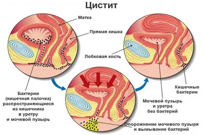 Лечение недержания мочи у женщин