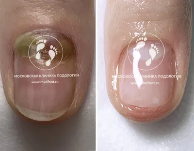 Goldaieva Olesia - OOPS 🤭 ⠀ Дырочка! В ногте... Или Расщепление ногтевой  пластины. ⠀ Возникает, как правило, в следствии чрезмерного давления и  истончения ногтя в проксимальной зоне. Также причиной может послужить  прокол,