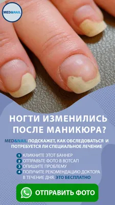 Медицинский маникюр при грибке (ФОТО) - trendymode.ru