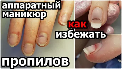 Пропилы ногтевой пластины: причины, последствия, восстановление