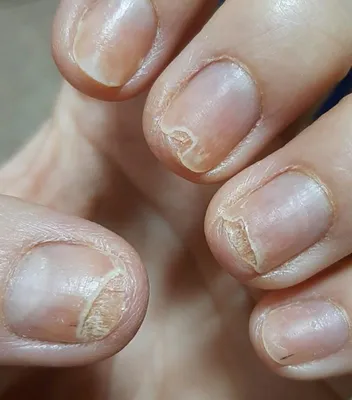 Последствия пропилов ногтевой пластины☝️ Пропилы при работе с кутикулой и  птеригием могут привести к истончению ногтевой пластины. А это… | Instagram