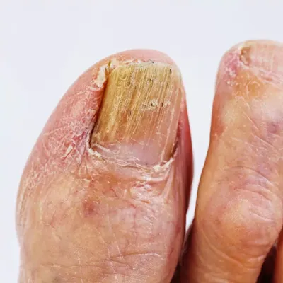 Последствия пропилов ногтевой пластины☝️ Пропилы при работе с кутикулой и  птеригием могут привести к истончению ногтевой пластины. А это… | Instagram