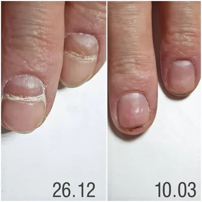 Почему на ногтях появляются белые пятна | РБК Украина