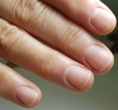 Синдром зеленых ногтей – причины, симптомы, лечение и способы профилактики