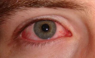 История болезни, диагноз: Герпетический дисковидный кератит левого глаза |  Экзамены Офтальмология | Docsity