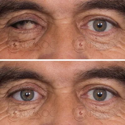 Instruction. How to remove an eye prosthesis? Наглядная инструкция по  снятию глазного протеза. #какснятьглазнойпротез #какснятьпротез  #глазнойпротезснять... | By Глазное протезирование и глазные протезы  \"ЦентрГлазОмск\" | Facebook