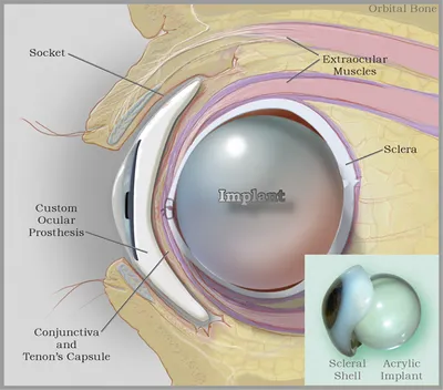 Восстановление глаза, дефектов глаз в Москве. Глазное протезирование.  Эктопротезы орбиты глаза