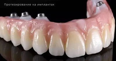 Протез на имплантах: цена несъемного протезирования и установки мостов в  стоматологии Доктор Бон