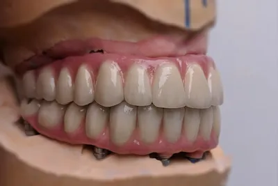 Протезирование зубов на имплантах, виды и цены протезов