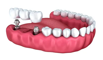All-on-6® — несъемный полный зубной протез на шести имплантах - Центр  приватной стоматологии «Доктор Левин»