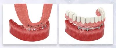 Протезирование зубов на имплантах - цена в Днепре | Клиника ДантистЪ