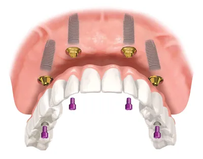 Технология all-on-4 и другие методы, которые позволяют установить зубы за 1  день