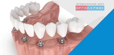 Установка несъемного протеза на 4 имплантах в Люберцах 🏥 Протезирование  зубов в стоматологии «Белый медведь»