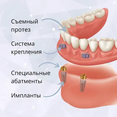 Съемное протезирование на имплантах