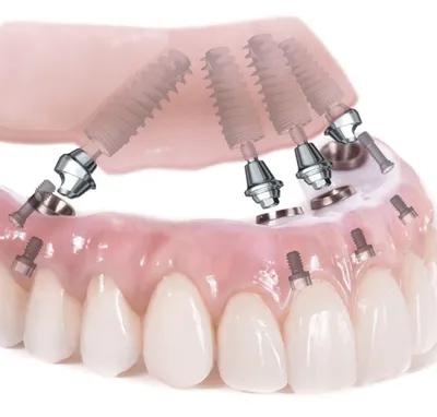 Протезирование зубов на имплантах — цены, установка съемных и несъемных  протезов на имплантах