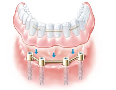 Съемные и условно-съемные зубные протезы на имплантах: виды, плюсы и  минусы, отзывы.