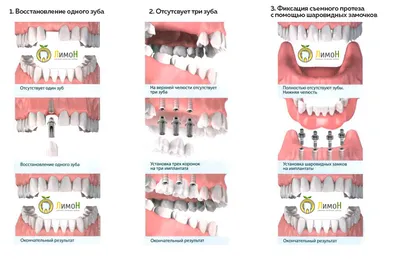 Протезирование зубов на имплантах в Днепре без выходных | Стоматология  \"Полимед\"