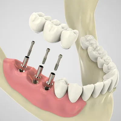 Протезирование на имплантах: виды протезов, преимущества, противопоказания
