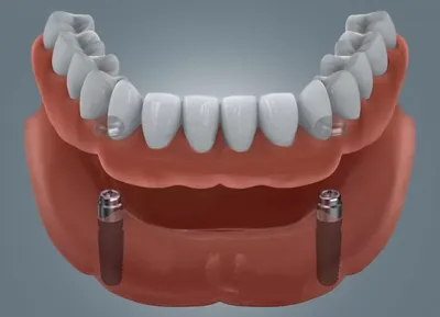 Протезирование зубов на 4 имплантах | Эликсир-Дента