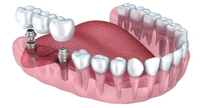 Балочное протезирование в ТОП1 клинике Москвы - Немецкий имплантологический  центр