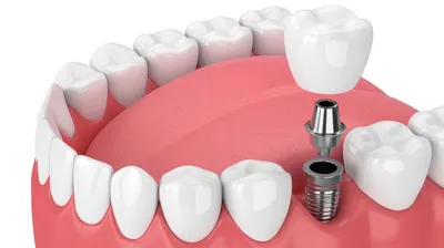 Несъемный зубной протез на имплантах - Стоматологическая клиника Эстетика  Новосибирск