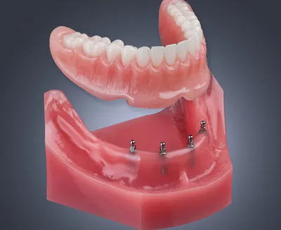 Протезирование на имплантах :: Зубные протезы на штифтах в 32Dent
