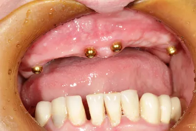 Несъемные зубные протезы на имплантах – цены, виды, отзывы