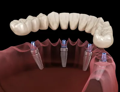 Полные протезы на имплантах – когда свои зубы уже не сохранить