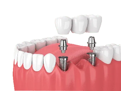Протезирование на имплантах при полном отсутствии зубов | НАВА