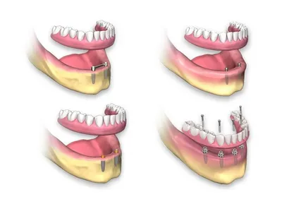 Интересные особенности протезирования на имплантах при полном отсутствии  зубов