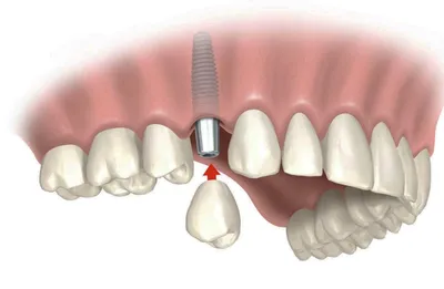 Зубные протезы на имплантатах