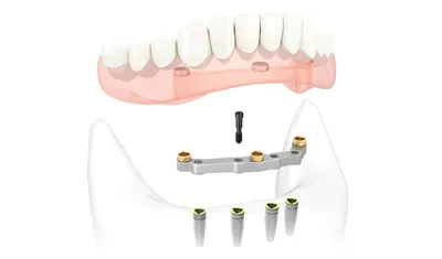 Протезирование зубов на 4 имплантах | Стоимость полного несъемного  протезирования на имплантах при отсутствии зубов