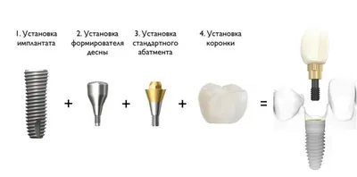 Полное протезирование зубов имплантами. Виды и цены в Ланри Клиник