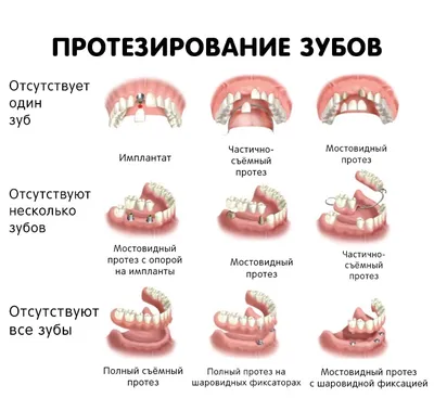 Протезы на зубы фото фото