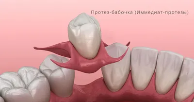 Силиконовые протезы зубов - Семейная стоматология