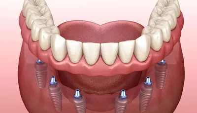 Акриловые съемные протезы для зубов в Омске по низким ценам в стоматологии  Ортодонт-центр