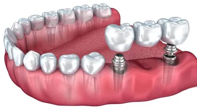 Протез на имплантах: цена несъемного протезирования и установки мостов в  стоматологии Доктор Бон