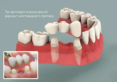 Съёмные протезы - Стоматологический центр «ШЭН»