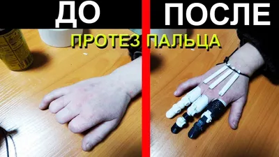 В Тольятти начали производить протезы пальцев руки | TLT.ru - Новости  Тольятти
