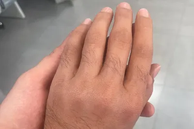 Силиконовый палец: протезы пальцев рук и ног ➤➤Эпитетика