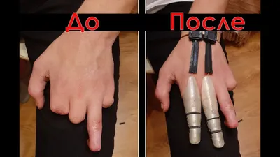 ПРОТЕЗ ПАЛЬЦА. Функциональный протез на 3 пальца. Обморожение  (указательный, средний, безымянный) - YouTube